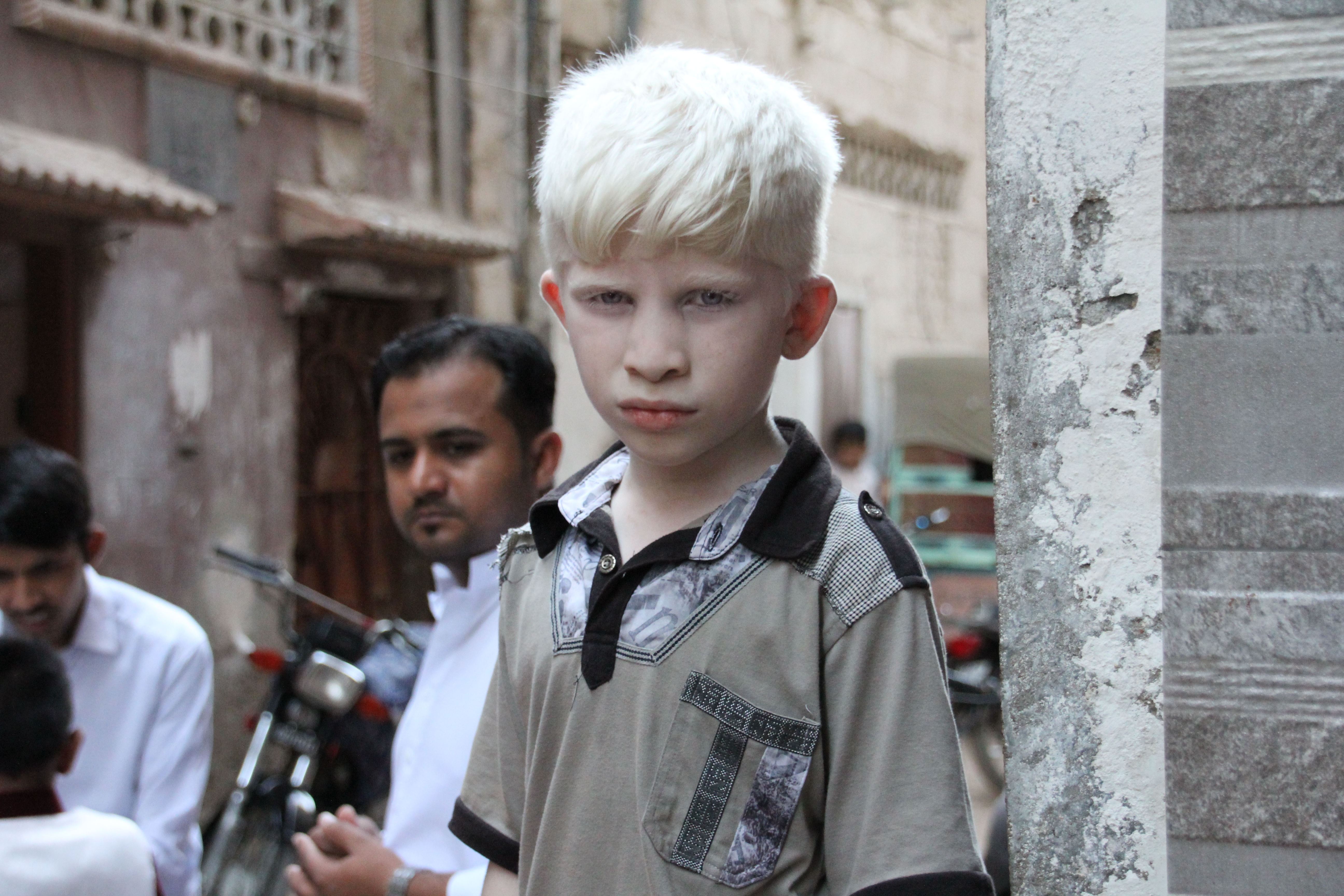 Niño con albinismo