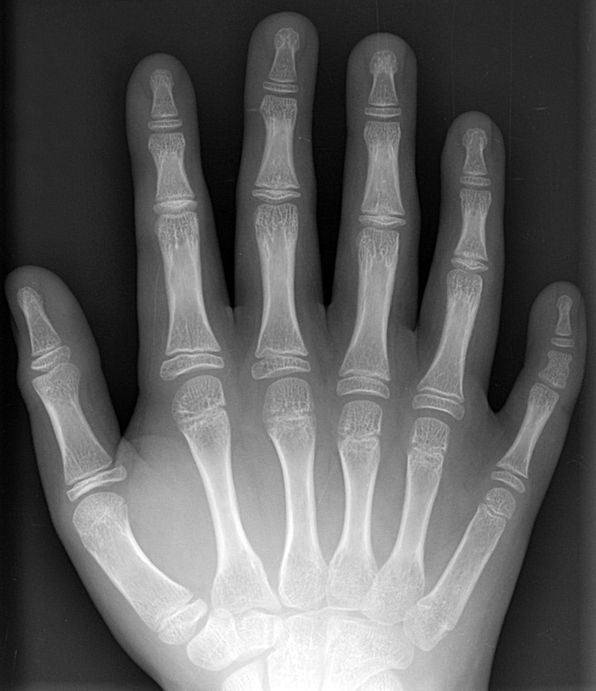 Radiografía de mano de una persona con polidactilia
