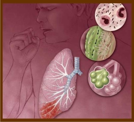 Focus on the respiratory system with bronchopnmeumonia