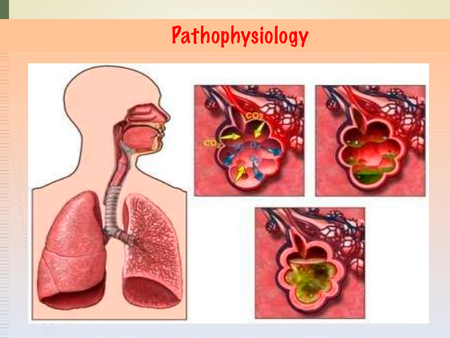Pathophysiology of pneumonia
