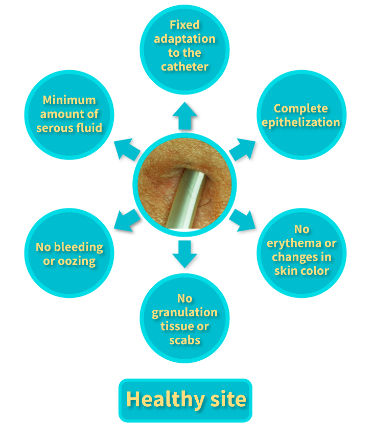 Features of the healthy catheter insertion site for PD