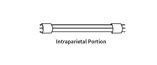 Porción intraparietal del catéter para DP