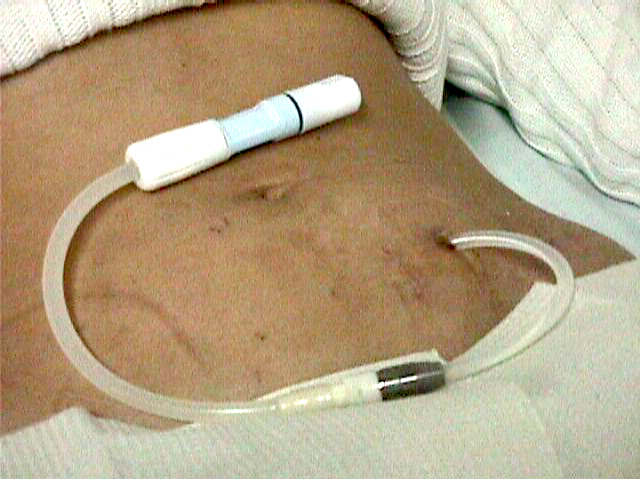 Installation of the catheter by surgical technique