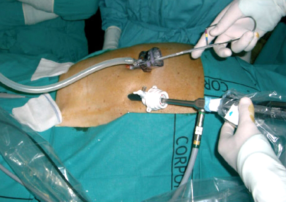 Installation of the catheter by laparoscopy