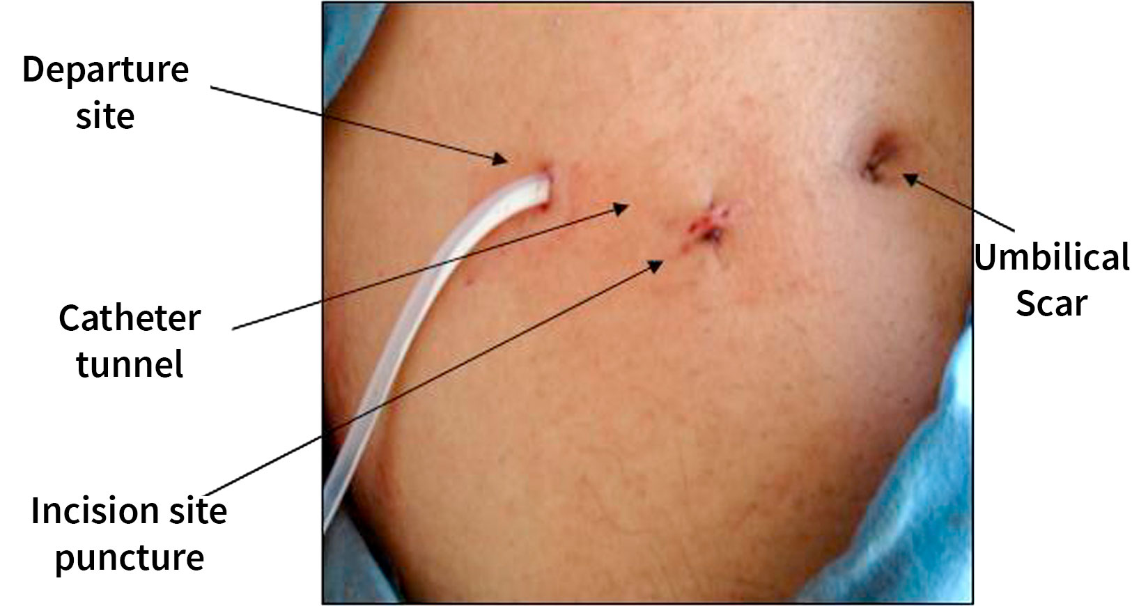 Installation of the catheter by percutaneous insertion