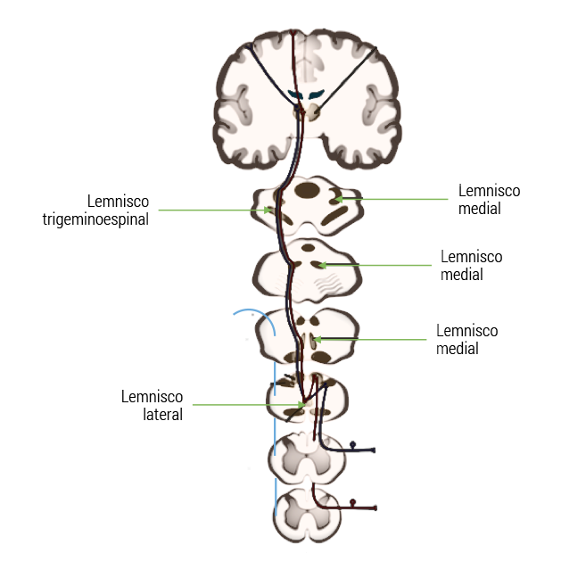 Corte coronal de cerebro mostrando ubicación de lemnisco trigeminoespinal en la parte superior, lemnisco medial en la parte media y lemnisco lateral del lado izquierdo.