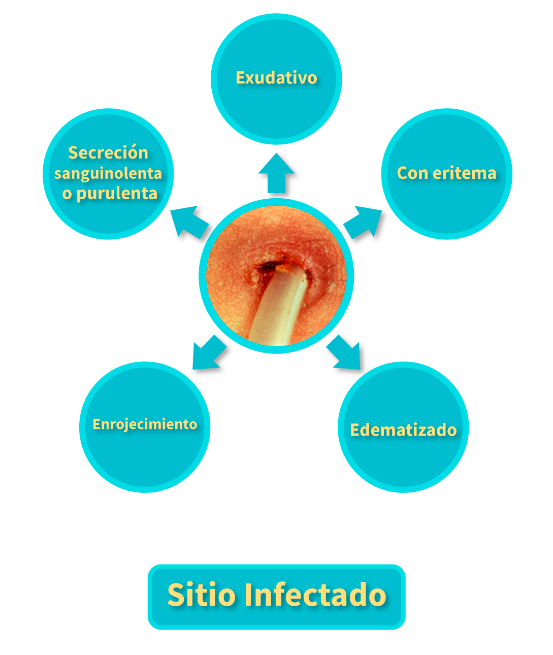 Características del sitio sano de inserción del catéter para DP