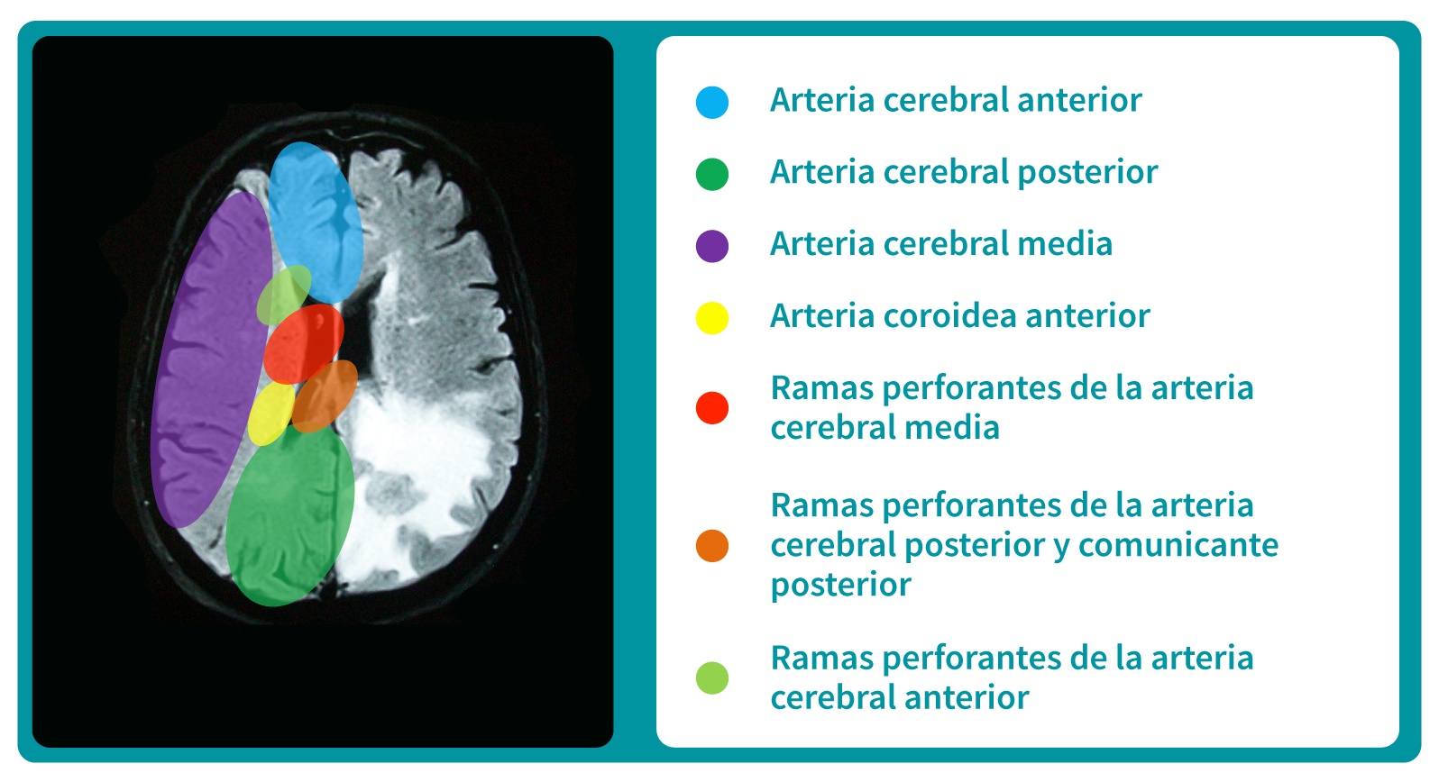 Corte transversal de cerebro humano, el circuito cerebral arterial y sus principales áreas de irrigación